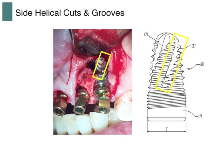 Active threads and lateral cutting grooves on the outer body portion of the implant shave off portions of under-drilled autogenic osteotomy site bone during insertion, contributing to step-locking and optimal primary stability.