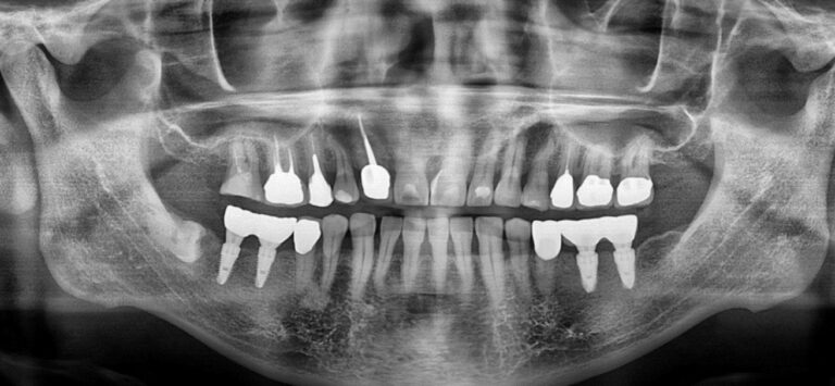 Preoperative radiograph revealing a vertical fracture on tooth #2. Note the proximity of the sinus floor to the root tip, which would leave the apical socket close to the sinus floor following extraction.