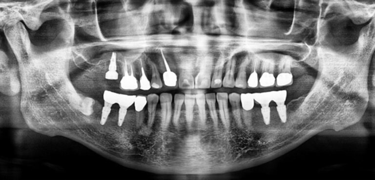 A radiograph directly after surgery following completion of the 5-in-1 Technique (i.e., extraction, implant placement, sinus lift, bone graft, and placement of a wide gingival healing abutment).