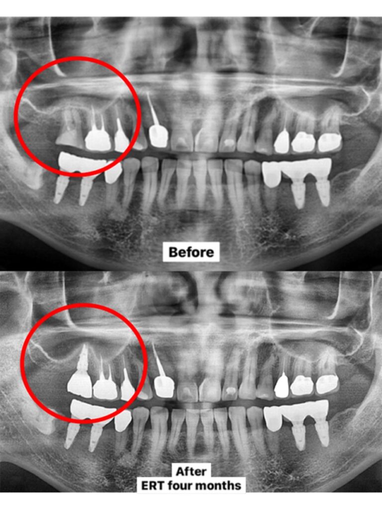 Comparison radiograph before the 5-in-1 Technique and 4 months after surgery. Since no additional surgeries were required, the total EFR-Time was only 4 months.
