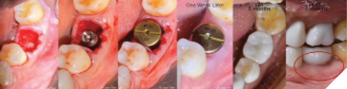 Wide healing abutments, provisional restorations in esthetic areas helped to preserve the keratinized tissue.