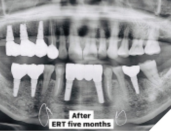 Four months after the 5-in-1 Technique was performed, final impressions were taken without the need for a second surgery or further local anesthesia