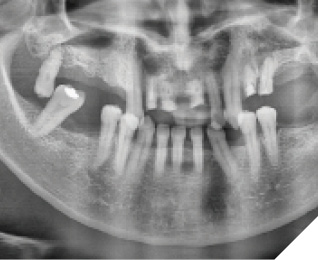 Radiographic examination indicated sites with residual roots (#2-5, #14 and #15) and unrestorable teeth (#1, #7-10, #12 and #13) that would be extracted.