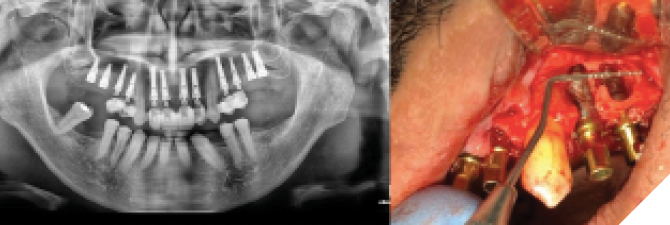 13. All hopeless teeth and residual roots were extracted under local anesthesia, and the appropriate hydraulic sinus lifts, bone grafts, and implants placed. 14. Despite the presence of large apical lesions at #12 and #13 that fenestrated through the buccal plate, immediate implant treatment could still be offered to the patient based on the implant’s strong primary stability, being over 50 ncm torque.