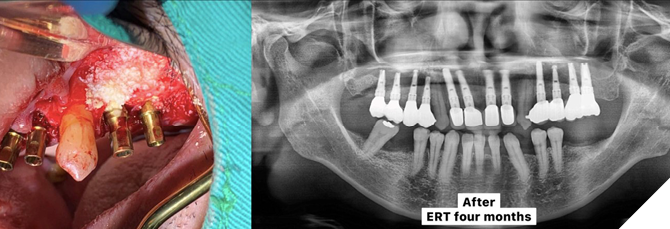 15. Strong primary stability was achieved with only bone graft material and sutures, enabling immediate placement of provisional restorations. 16. Postoperative radiograph following delivery of the final restorations.