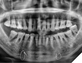 Preoperative radiograph of a patient who presented with serve periodontal disease, mobility grade 2-3, and unrestorable teeth (#1-4; #17, #19; #23-25; #26, #30 and #31).