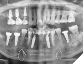 . The osteotomies and any necessary sinus lifts were accomplished using the Onedrill™system, the selected implants sizes were chosen to maximize the step-locking capabilities to maximize primary stability.