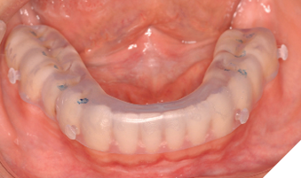 airVata lower component in patient’s mouth.