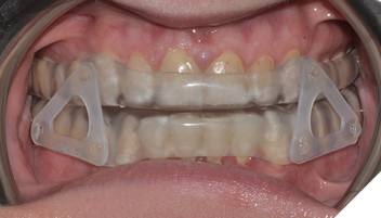 airVata frontal view in patient’s mouth.