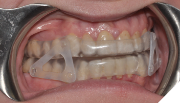 airVata right lateral view in patient’s mouth.