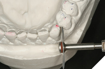 Reshaping lower left canine-facial side.