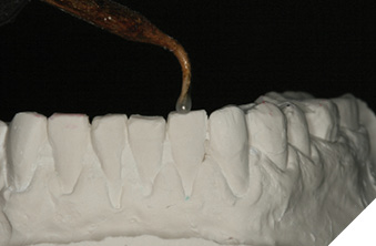 Wax up lower incisal edge.