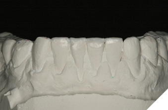 Completion of mandibular incisal plane.