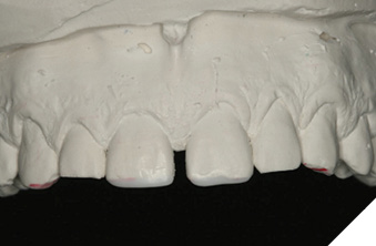 Maxillary central incisal edge completion.