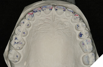 Maxillary arch equilibrated.