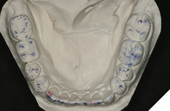 Mandibular arch equilibrated.