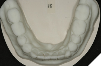 Digital wax up mandibular teeth (32,31,41,42)