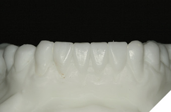 Digital wax up of mandibular (32, 31,41, 42).