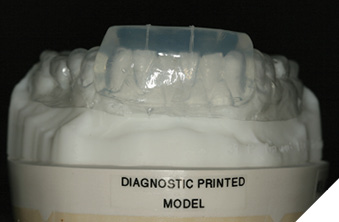 Clear silicon matrix mandibular anterior teeth.