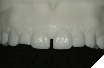 Digital wax up teeth 11, 21.