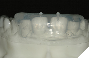 Maxillary silcone matrix teeth 11, 21.