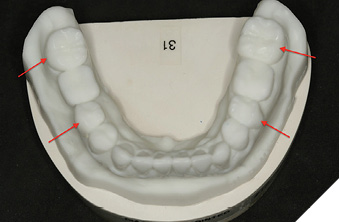 Digital wax up teeth
32-42 & 37, 35, 45, 47.