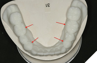 . Digital final wax up remaining teeth
(36, 34, 44, 46).