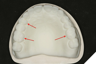 Digital wax up teeth 11, 21 & 16, 14, 26.