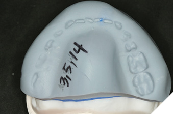 Segmented matrix maxillary teeth 16, 14, 26.