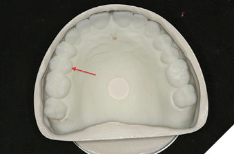 Digital wax up remaining maxillary teeth (15).