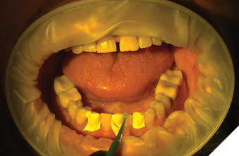 Bonding teeth (32, 41).