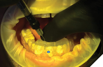 Injectable composite application teeth (32, 41).