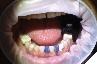 Acid etch teeth (32, 41).
