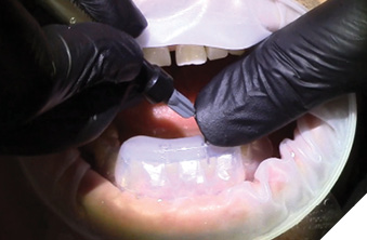 Injectable composite application teeth (32, 41)