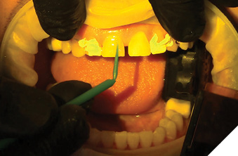 Bonding maxillary central incisors.