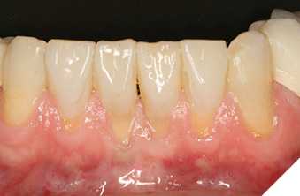 Completed restorations (32,31,41,42).