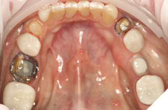 Fabrication of provisionals teeth (37 35 45 47).