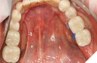 Completion of mandibular posterior provisionals (36, 34, 44, 46)