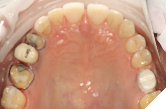 Preparation of maxillary teeth (16, 15, 26).