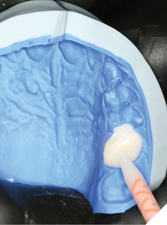 Loading putty matrix with provisional material maxillary arch.