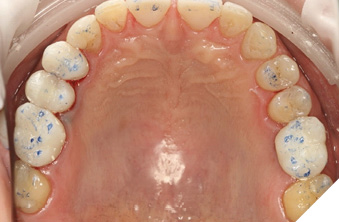 Complete maxillary provisionals & start of equilibration.