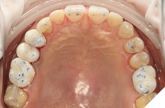 Maxillary arch equilibration.