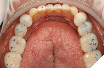 Mandibular arch equilibration.