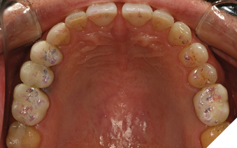 Maxillary arch equilibration completed.