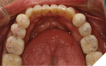 Mandibular arch equilibration completed.