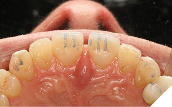 Anterior guidance in harmony with envelope of function.