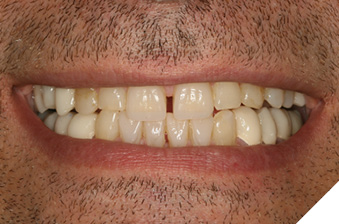 Smile view
of composite and provisional restorations.