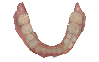 Post op digital scan mandibular arch. 35B. Post op digital scan maxillary arch.