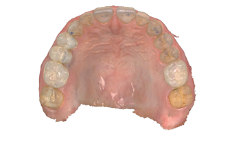 Post op digital scan maxillary arch.