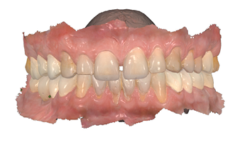 Post op digital scan facial view.
